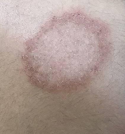 520px-Dermatophytosis.jpg